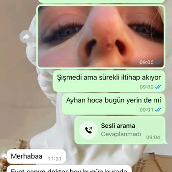 Başarısız Burun İp Askı İşlemi Sonrası Süregelen Sorunlar