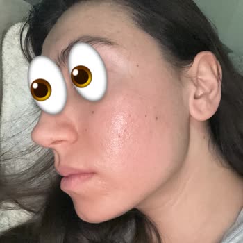 Cilt Tahrişi Yapan Ürün İçin Acil Çözüm Gerekliliği