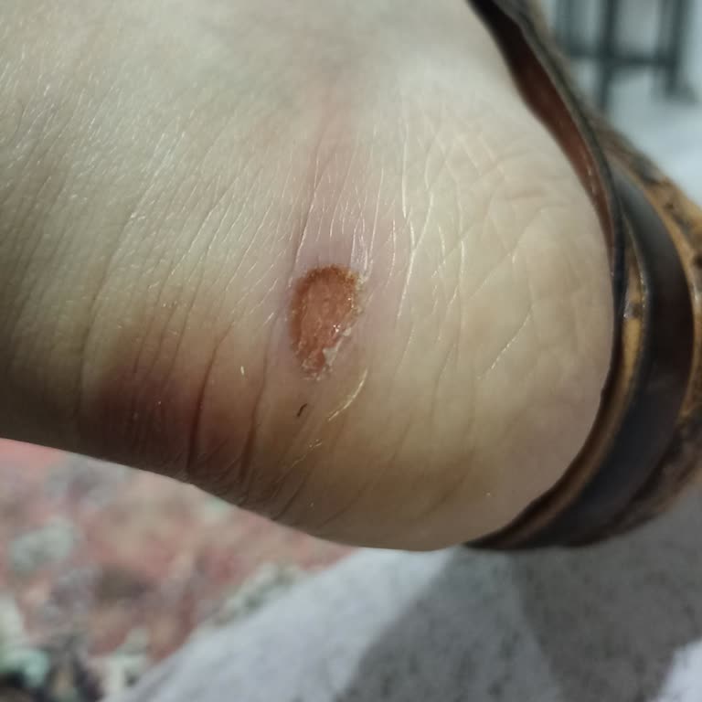 Ayakkabı Kullanımında Topuk Sorunu