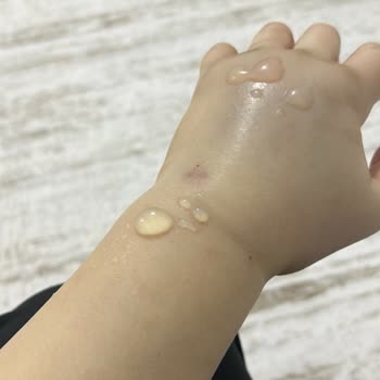 Hastanede Yanlış Damar Yolu Açma Mağduriyeti