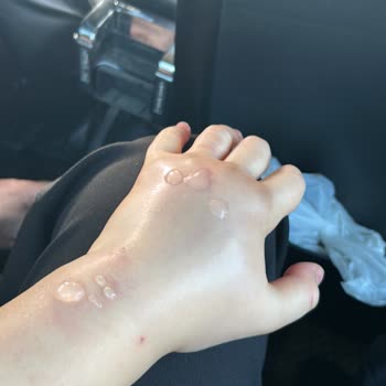 Hastanede Yanlış Damar Yolu Açma Mağduriyeti