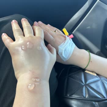 Hastanede Yanlış Damar Yolu Açma Mağduriyeti