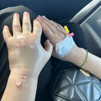 Hastanede Yanlış Damar Yolu Açma Mağduriyeti