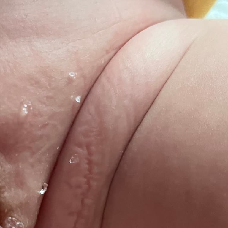 Molfix Bebek Bezinde Kristal Oluşumu Ve Rahatsızlık