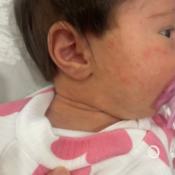 Bebek Ürünlerinde Beklenmedik Cilt Reaksiyonu