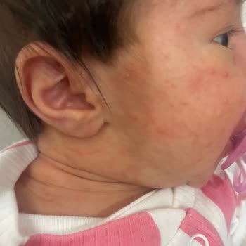 Bebek Ürünlerinde Beklenmedik Cilt Reaksiyonu