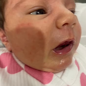 Bebek Ürünlerinde Beklenmedik Cilt Reaksiyonu