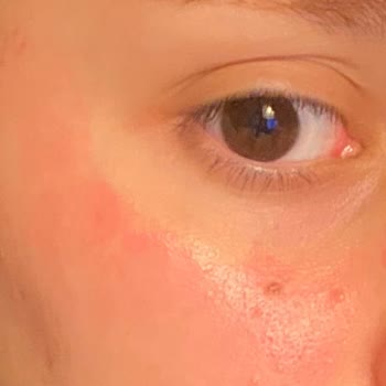 Skin401 Niacinamide Serumu Cilt Reaksiyonu Yarattı