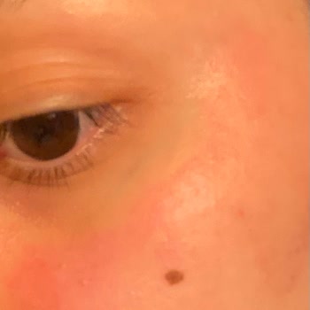 Skin401 Niacinamide Serumu Cilt Reaksiyonu Yarattı