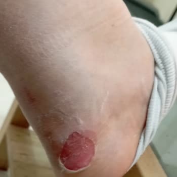 Zara Chelsea Botlar Ayak Sağlığını Tehdit Ediyor: İade Talebi