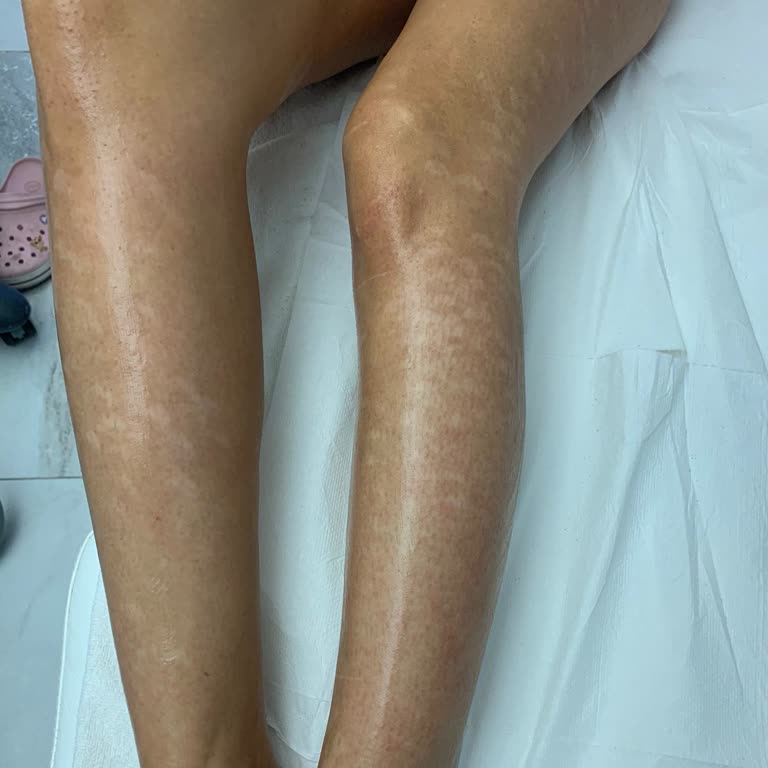 Yanlış Bilgilendirme Ve Yanık Problemi