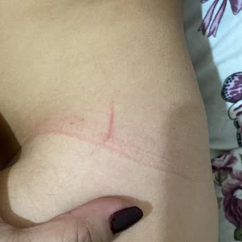 Bilge Şirinler Kreş Anaokulu Oğlum Sürekli Vücudunda Çiziklerle Geliyor