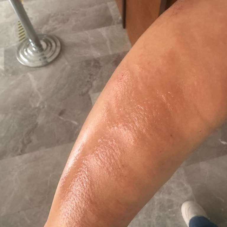 Lazer Sonrası Cilt Sorunları Ve İlgisizlik