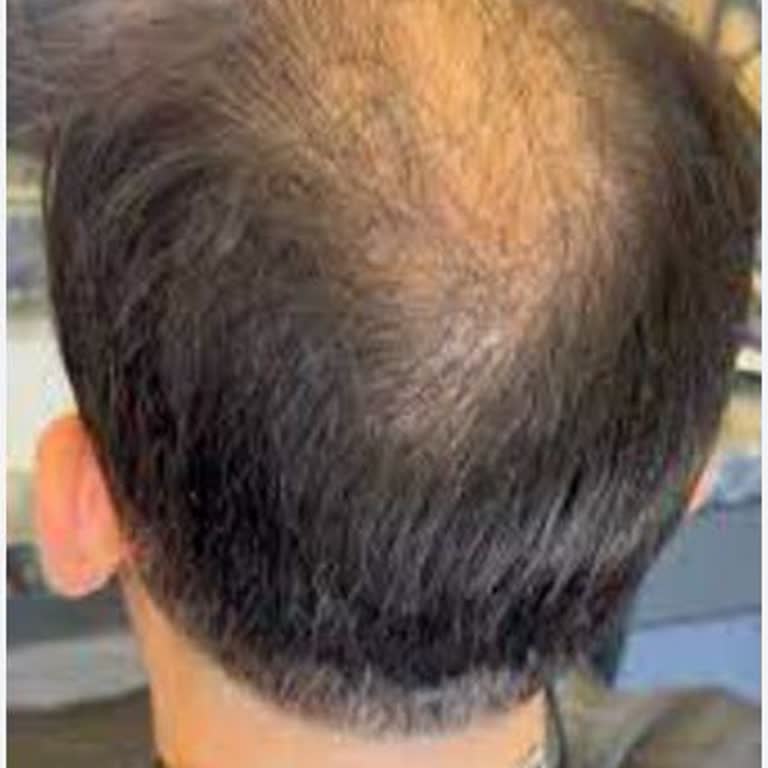 Esteworld Saç Ekiminde Hayal Kırıklığı Ve Çözüm Beklentisi