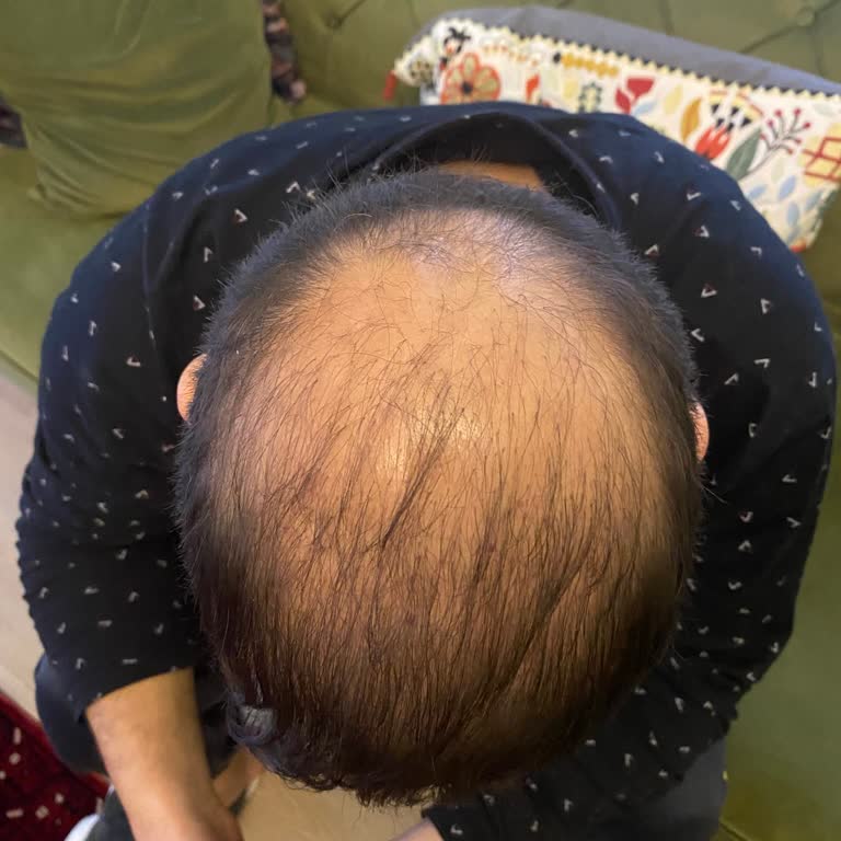 Hayal Kırıklığı Yaratan Saç Ekimi Deneyimi