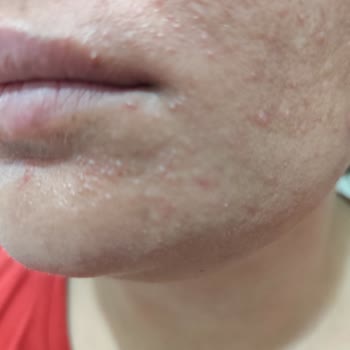 L'Oreal Revitalift Clinical İle Ciltte Kaşıntı Ve Sivilce Sorunu