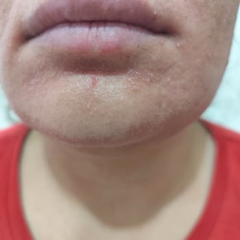 L'Oreal Revitalift Clinical İle Ciltte Kaşıntı Ve Sivilce Sorunu