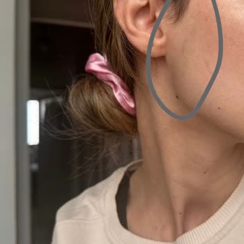 Lazer Tedavisi Sonrası Beklenmedik Sorunlar