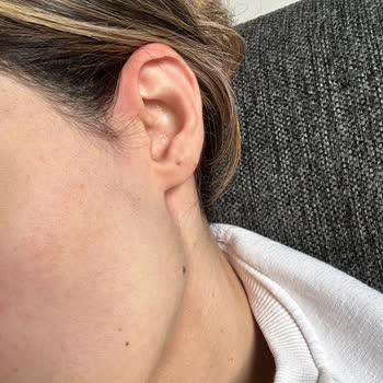 Lazer Tedavisi Sonrası Beklenmedik Sorunlar