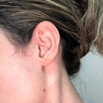 Lazer Tedavisi Sonrası Beklenmedik Sorunlar