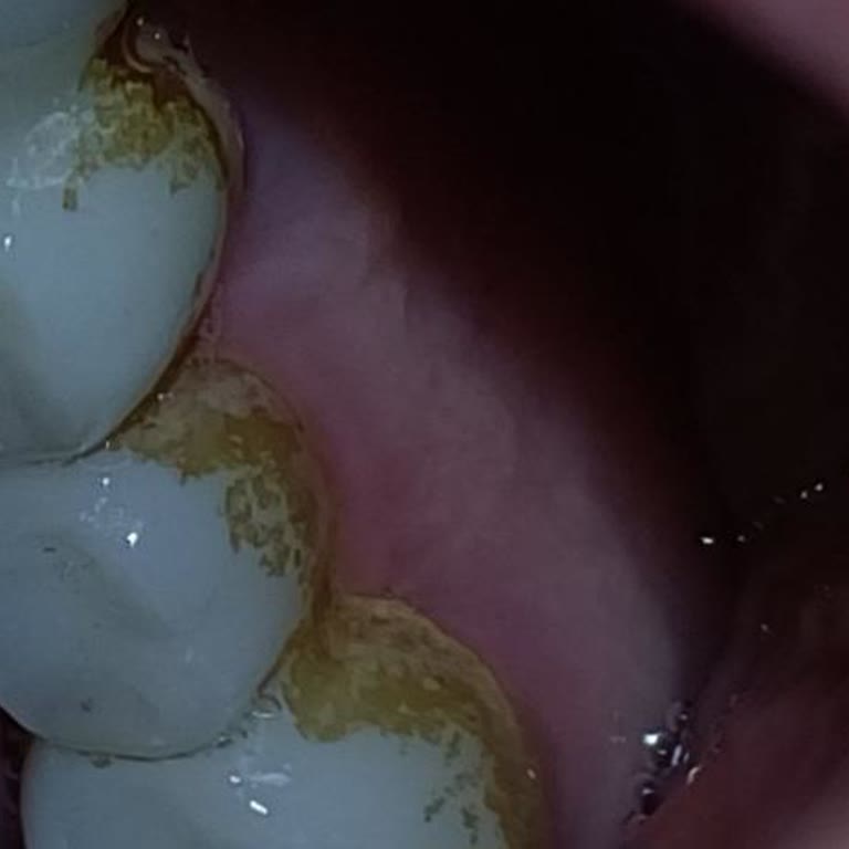 Hospitadent Kocaeli'nde Bitmeyen İmplant Sorunu