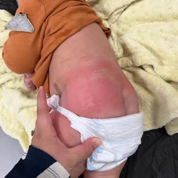 Bebeğimde Yan Etki Yapan Ürün Ve Stresli Süreç