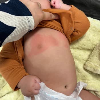 Bebeğimde Yan Etki Yapan Ürün Ve Stresli Süreç