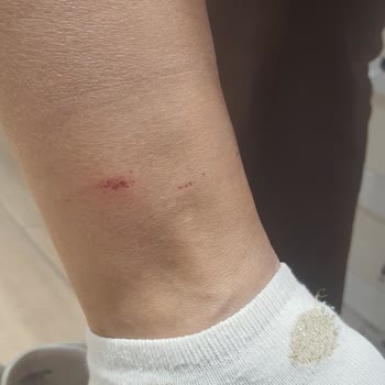 Deichmann Botları Bileklerimi Yaraladı!
