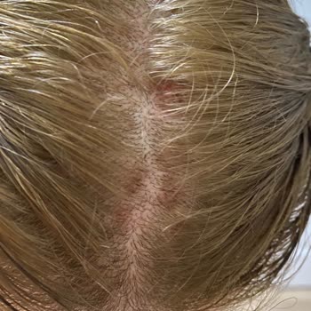 Saç Boyası Alerjisi: Ciddi Sağlık Sorunları