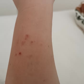 Versace Watch Caused Allergic Reaction—Requesting Refund