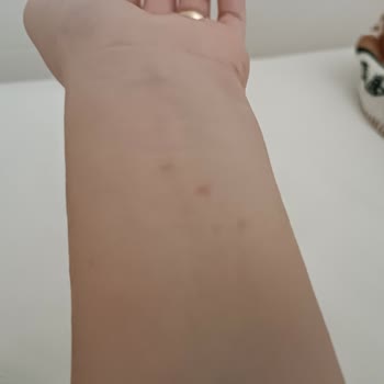 Versace Watch Caused Allergic Reaction—Requesting Refund