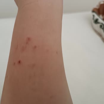 Versace Watch Caused Allergic Reaction—Requesting Refund