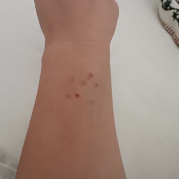 Versace Watch Caused Allergic Reaction—Requesting Refund