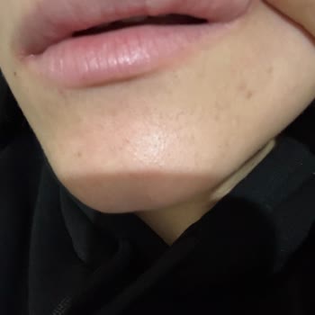 Estetikland Şişli Şubesinde Dolgu Kabusu