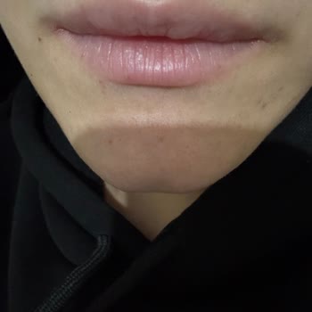 Estetikland Şişli Şubesinde Dolgu Kabusu