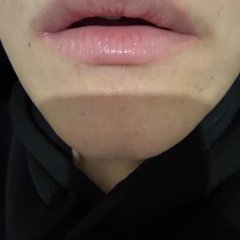 Estetikland Şişli Şubesinde Dolgu Kabusu