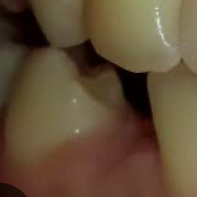 Diş Hekimi Derya Cingi Kalitesiz İşlem Diş Kaybı