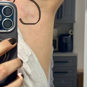 Rexona Roll On Kullanımı Sonrası Şiddetli Ağrı Ve Şişlik