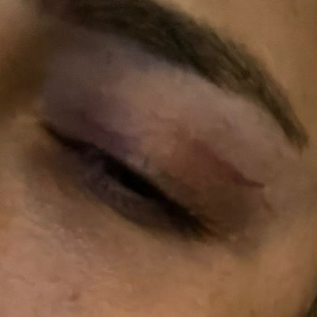 Ameliyat Sonrası İyileşmeyen İzler Ve Göz Yanması