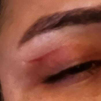 Ameliyat Sonrası İyileşmeyen İzler Ve Göz Yanması