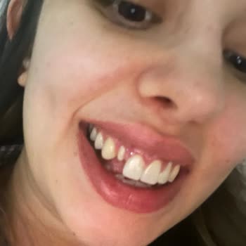 Diş Tedavisinde Hayal Kırıklığı Ve Maddi Mağduriyet