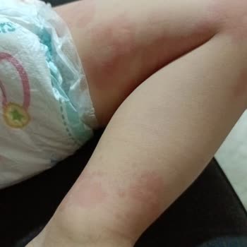 Prima Bez Alerjisi: Çocuğumun Sağlığını Tehdit Ediyor