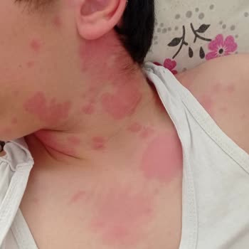 İbucold C Vitamini Kullanımı Sonrası Ciddi Reaksiyon