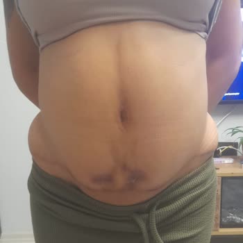 Bursa Medical Park'ta Liposuction Sonrası Hayal Kırıklığı