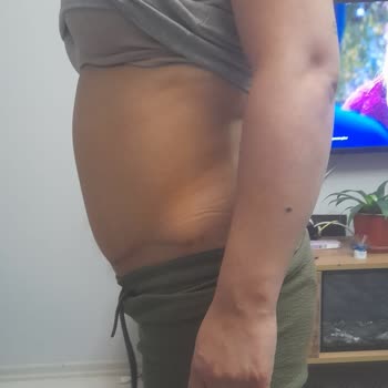 Bursa Medical Park'ta Liposuction Sonrası Hayal Kırıklığı