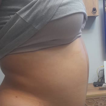 Bursa Medical Park'ta Liposuction Sonrası Hayal Kırıklığı