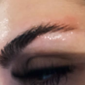 Kaş Sabitleyici Kullanımı Sonrası Ciddi Cilt Sorunları