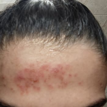 Cilt Bakımı Sonrası Kabus: Yanma, Kaşıntı Ve İlgisizlik