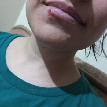 Ekin Ekinci Güzellik Salonu Yüzümde Bir Hafta Boyunca Geçmeyen Morluk