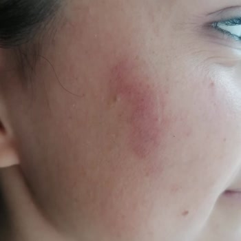 Ekin Ekinci Güzellik Salonu Yüzümde Bir Hafta Boyunca Geçmeyen Morluk